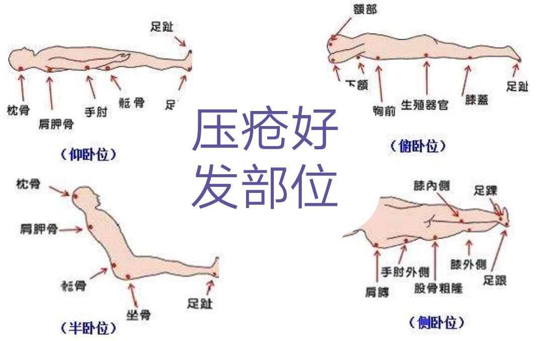 压疮的最新分期及护理措施,压疮的最新分期及护理措施有哪些，压疮最新分期与护理要点解析，全面揭示护理策略及措施