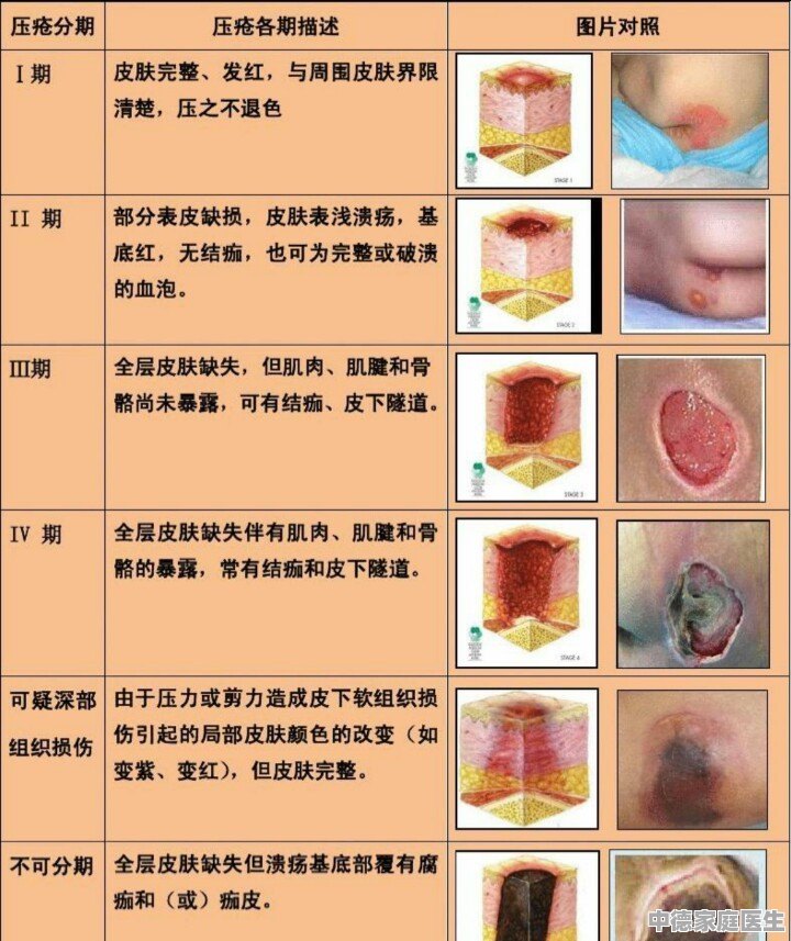 压疮的最新分期及护理措施,压疮的最新分期及护理措施有哪些