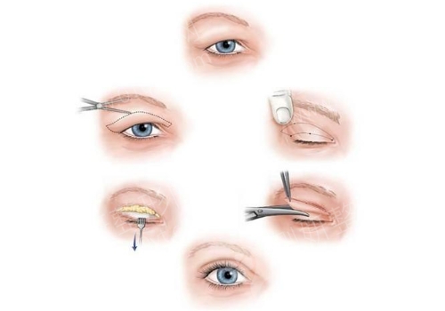 最新技术不开刀双眼皮，革新你的眼部魅力，革新眼部魅力，最新技术不开刀双眼皮手术介绍